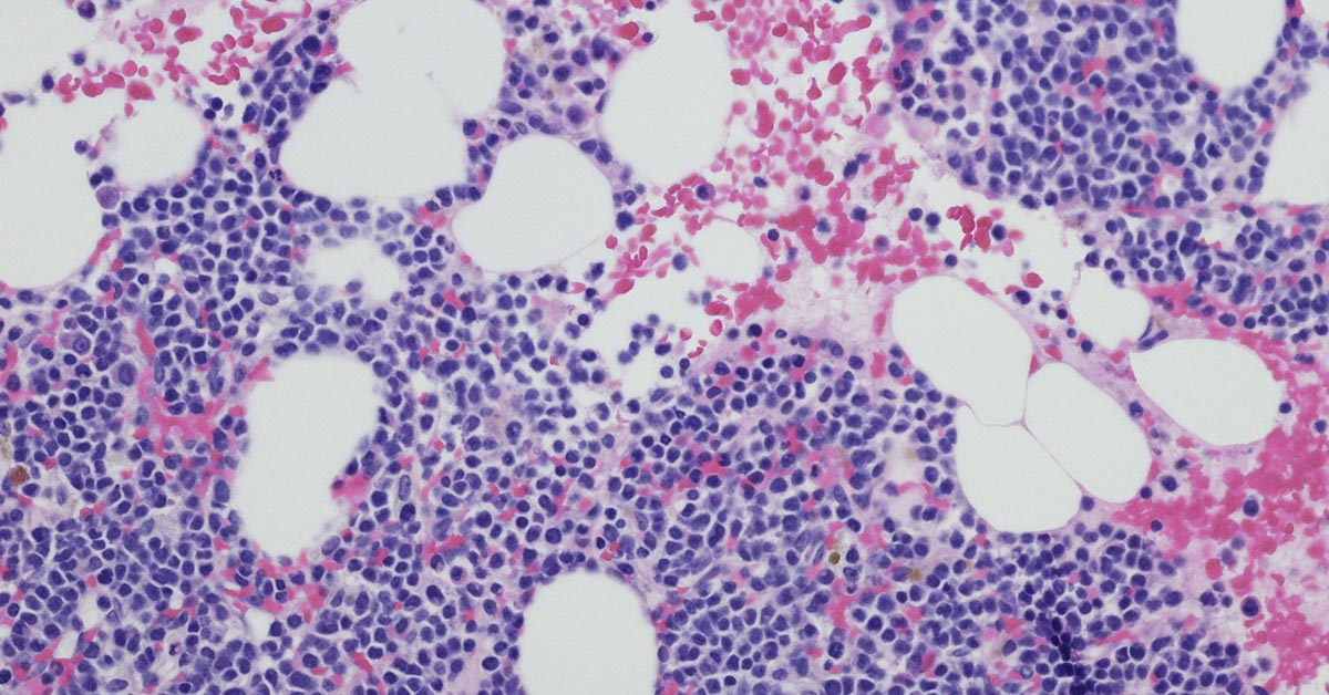 microscope view of myeloma